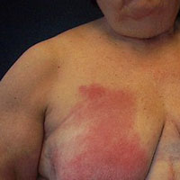 [ Skin or Lymph Vessel Infection ]